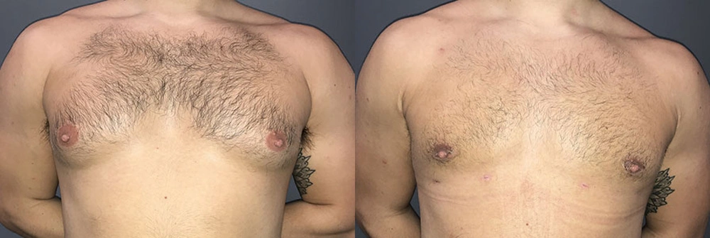Real Patient Results in Newport Beach, CA. Preformed by Semira Bayait, MD, FACS.