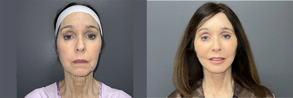 Real Patient Results in Newport Beach, CA. Preformed by Semira Bayait, MD, FACS.