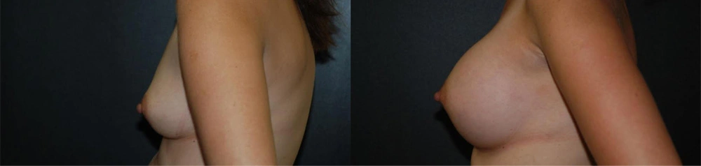 Real Patient Results in Newport Beach, CA. Preformed by Semira Bayait, MD, FACS.
