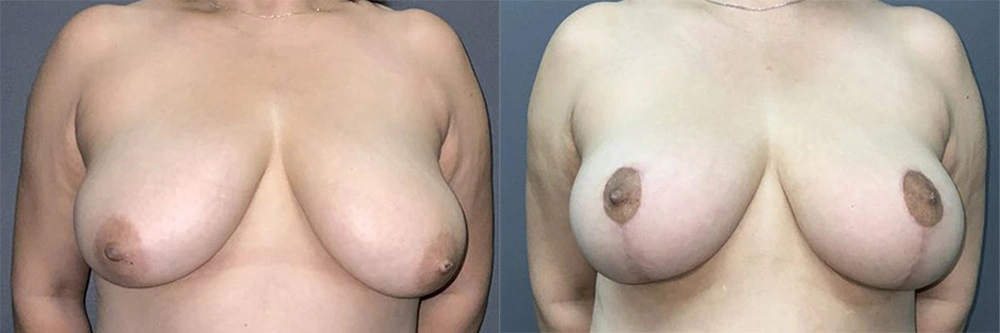 Real Patient Results in Newport Beach, CA. Preformed by Semira Bayait, MD, FACS.