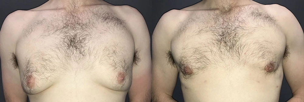 Real Patient Results in Newport Beach, CA. Preformed by Semira Bayait, MD, FACS.