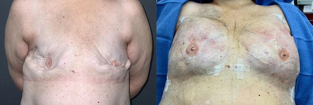Real Patient Results in Newport Beach, CA. Preformed by Semira Bayait, MD, FACS.