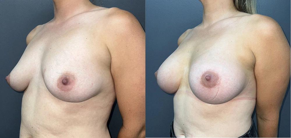 Real Patient Results in Newport Beach, CA. Preformed by Semira Bayait, MD, FACS.