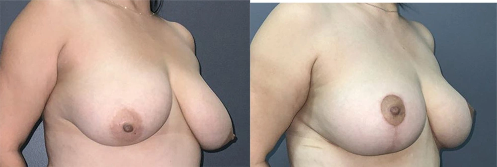 Real Patient Results in Newport Beach, CA. Preformed by Semira Bayait, MD, FACS.
