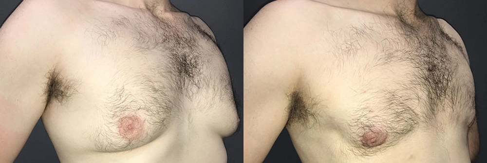 Real Patient Results in Newport Beach, CA. Preformed by Semira Bayait, MD, FACS.