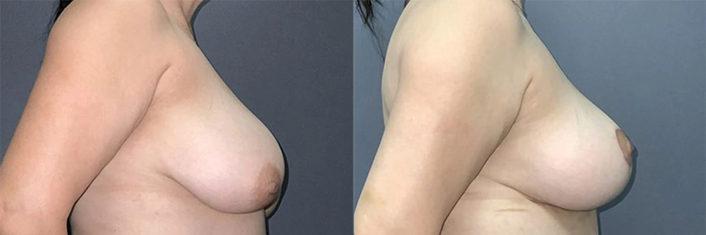 Real Patient Results in Newport Beach, CA. Preformed by Semira Bayait, MD, FACS.