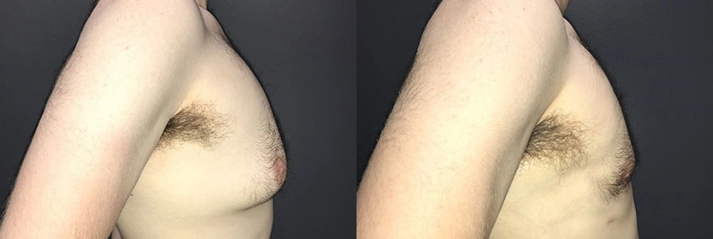 Real Patient Results in Newport Beach, CA. Preformed by Semira Bayait, MD, FACS.