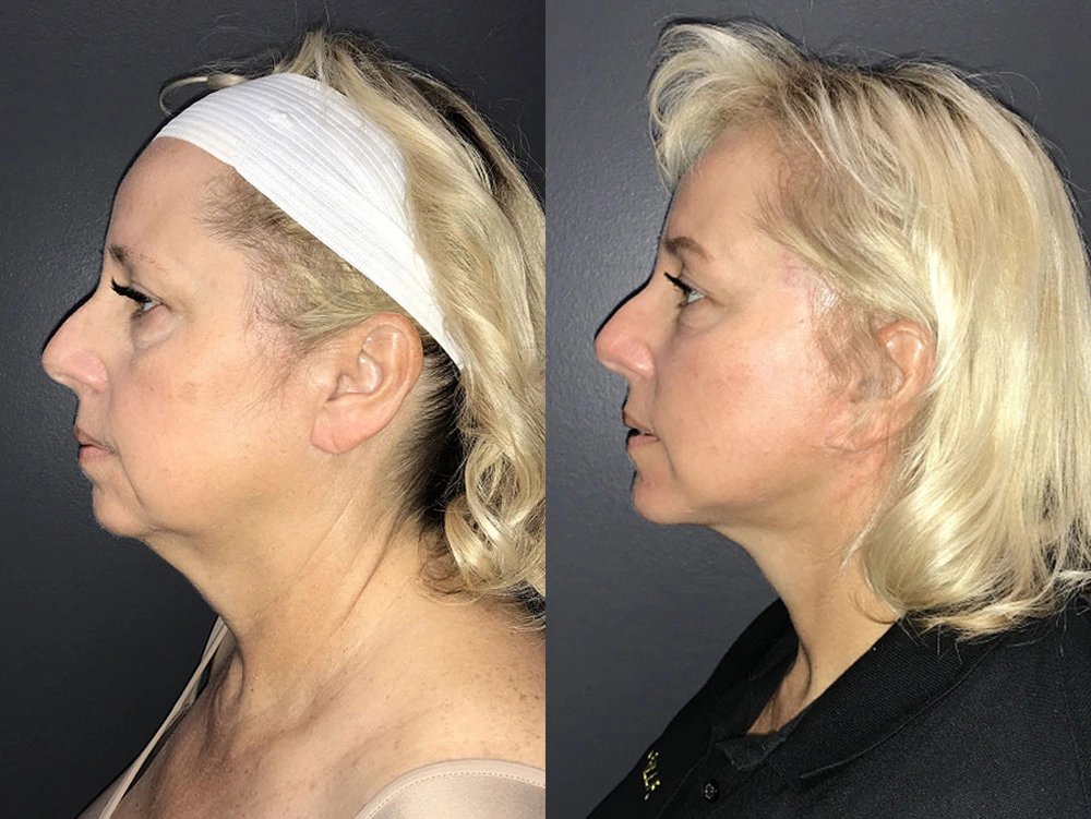 Real Patient Results in Newport Beach, CA. Preformed by Semira Bayait, MD, FACS.