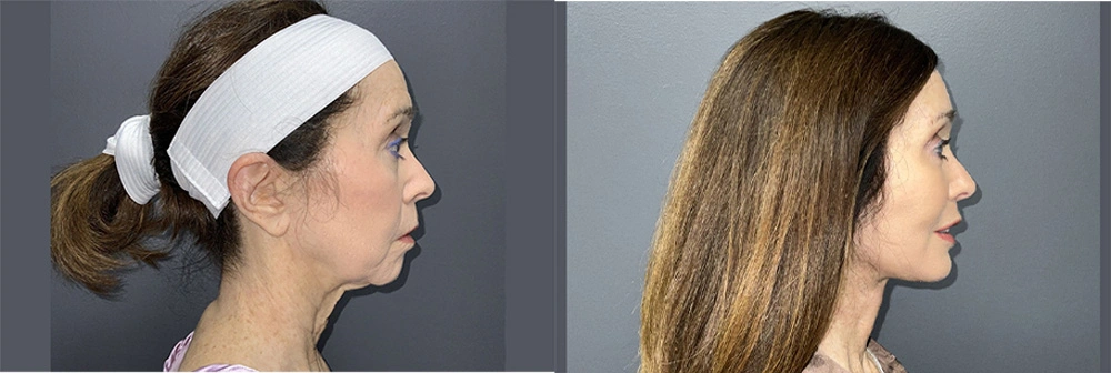 Real Patient Results in Newport Beach, CA. Preformed by Semira Bayait, MD, FACS.