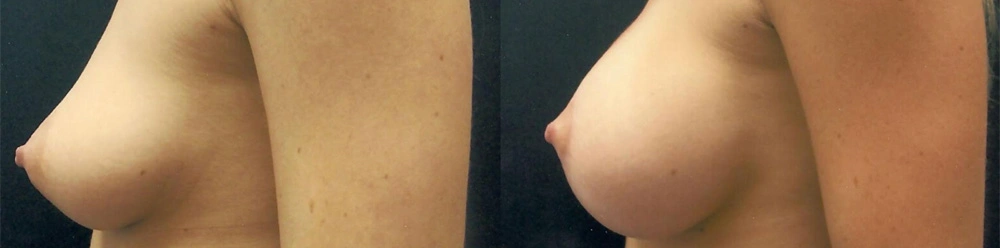 Real Patient Results in Newport Beach, CA. Preformed by Semira Bayait, MD, FACS.