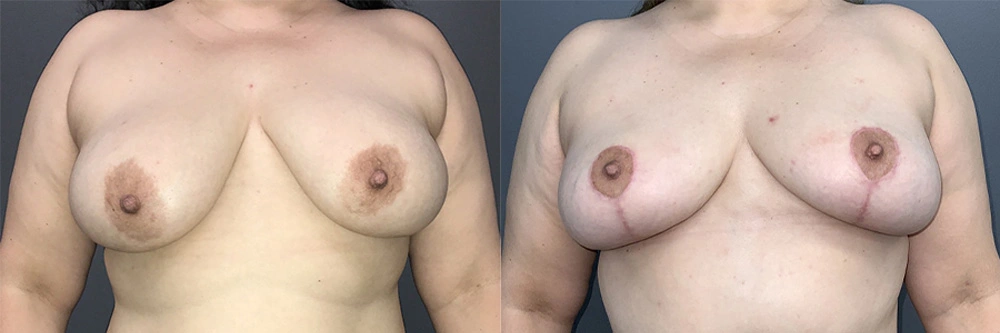 Real Patient Results in Newport Beach, CA. Preformed by Semira Bayait, MD, FACS.