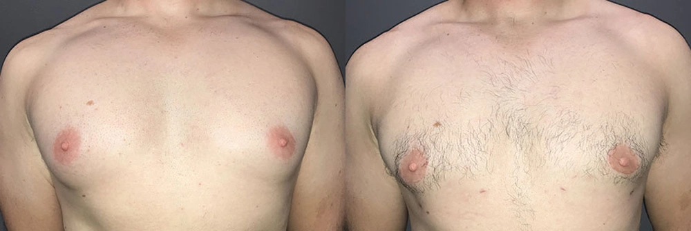 Real Patient Results in Newport Beach, CA. Preformed by Semira Bayait, MD, FACS.