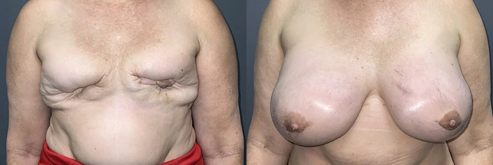 Real Patient Results in Newport Beach, CA. Preformed by Semira Bayait, MD, FACS.