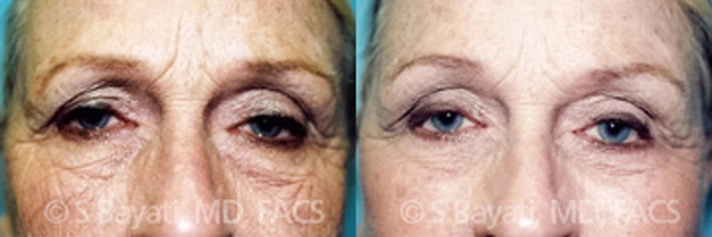 Real Patient Results in Newport Beach, CA. Preformed by Semira Bayait, MD, FACS.