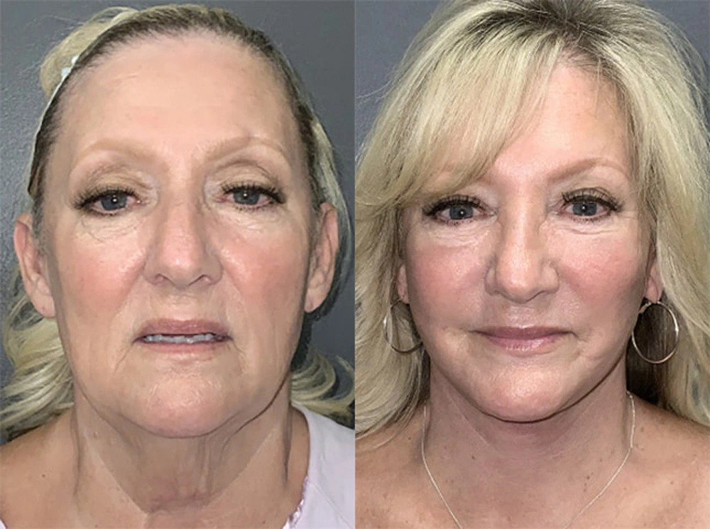 Real Patient Results in Newport Beach, CA. Preformed by Semira Bayait, MD, FACS.