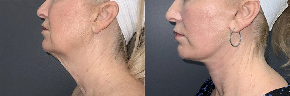 Real Patient Results in Newport Beach, CA. Preformed by Semira Bayait, MD, FACS.
