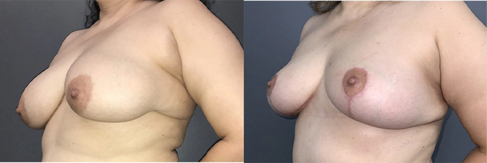 Real Patient Results in Newport Beach, CA. Preformed by Semira Bayait, MD, FACS.