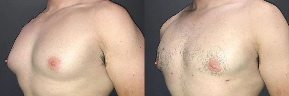 Real Patient Results in Newport Beach, CA. Preformed by Semira Bayait, MD, FACS.