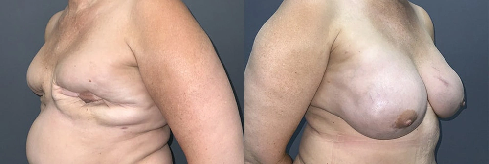 Real Patient Results in Newport Beach, CA. Preformed by Semira Bayait, MD, FACS.
