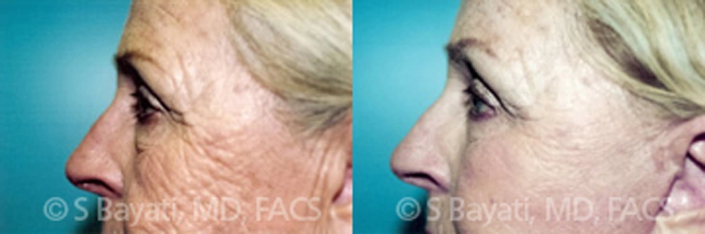 Real Patient Results in Newport Beach, CA. Preformed by Semira Bayait, MD, FACS.