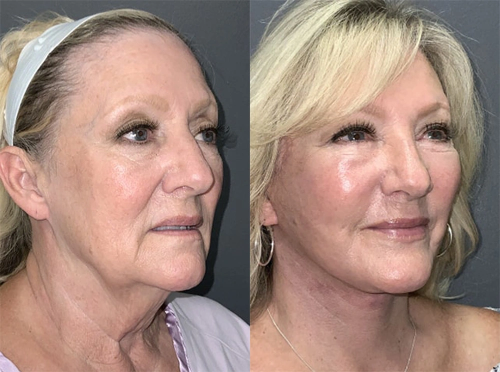 Real Patient Results in Newport Beach, CA. Preformed by Semira Bayait, MD, FACS.