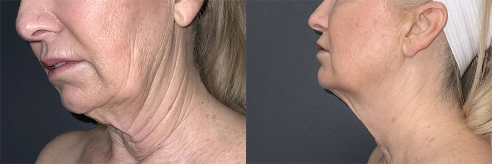 Real Patient Results in Newport Beach, CA. Preformed by Semira Bayait, MD, FACS.