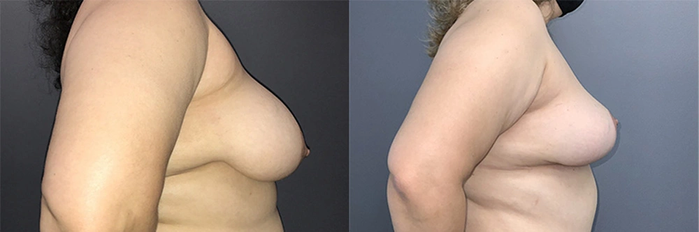 Real Patient Results in Newport Beach, CA. Preformed by Semira Bayait, MD, FACS.