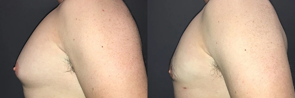 Real Patient Results in Newport Beach, CA. Preformed by Semira Bayait, MD, FACS.