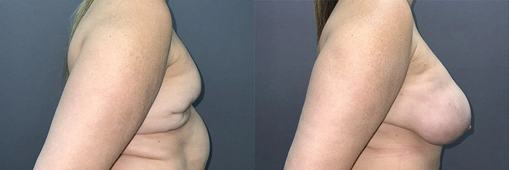 Real Patient Results in Newport Beach, CA. Preformed by Semira Bayait, MD, FACS.