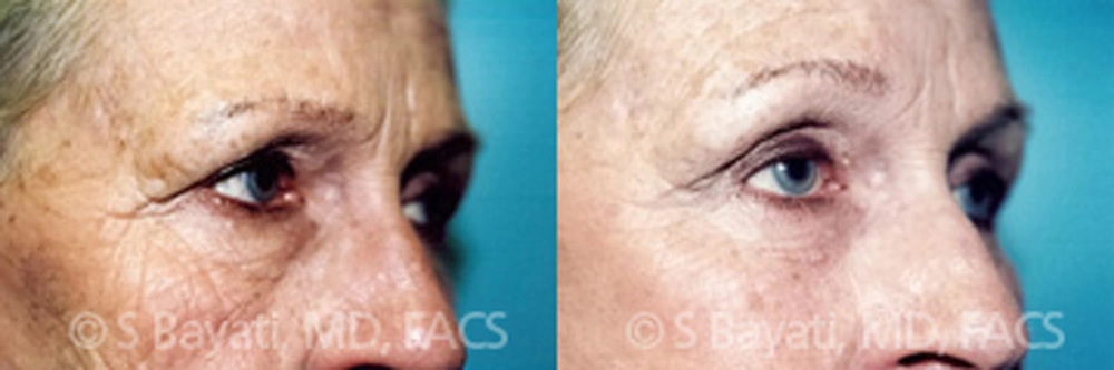 Real Patient Results in Newport Beach, CA. Preformed by Semira Bayait, MD, FACS.