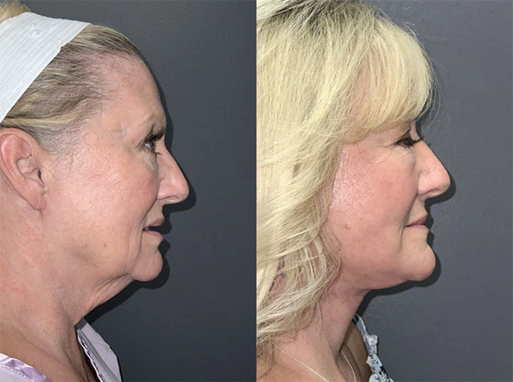 Real Patient Results in Newport Beach, CA. Preformed by Semira Bayait, MD, FACS.