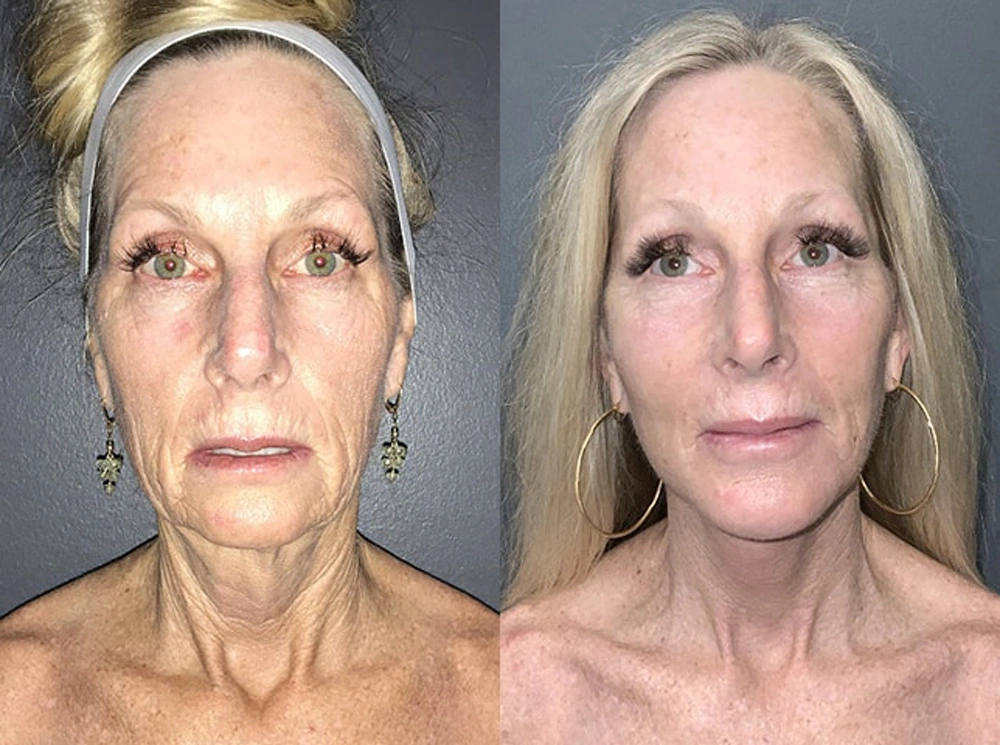 Real Patient Results in Newport Beach, CA. Preformed by Semira Bayait, MD, FACS.
