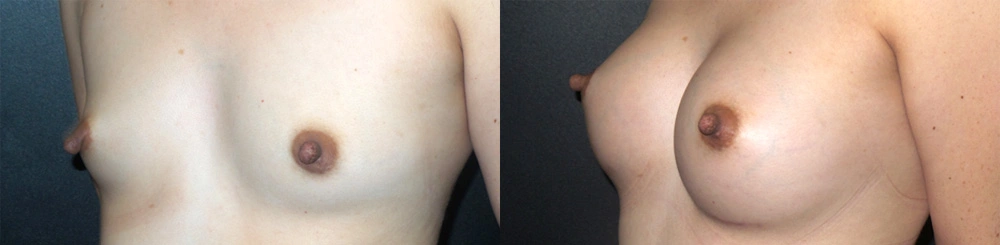 Real Patient Results in Newport Beach, CA. Preformed by Semira Bayait, MD, FACS.