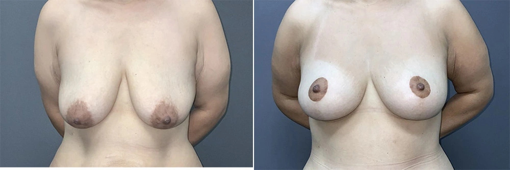 Real Patient Results in Newport Beach, CA. Preformed by Semira Bayait, MD, FACS.