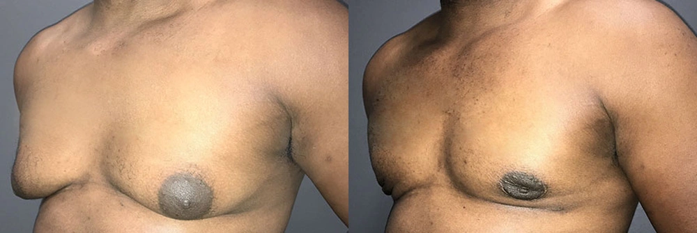 Real Patient Results in Newport Beach, CA. Preformed by Semira Bayait, MD, FACS.