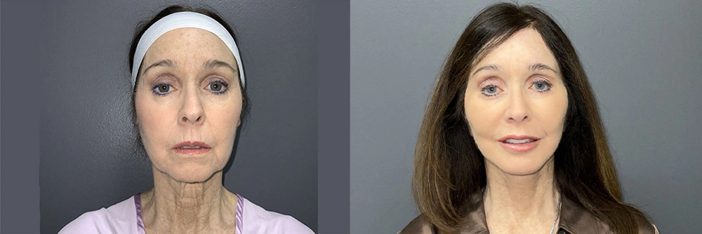 Real Patient Results in Newport Beach, CA. Preformed by Semira Bayait, MD, FACS.