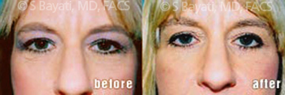 Real Patient Results in Newport Beach, CA. Preformed by Semira Bayait, MD, FACS.
