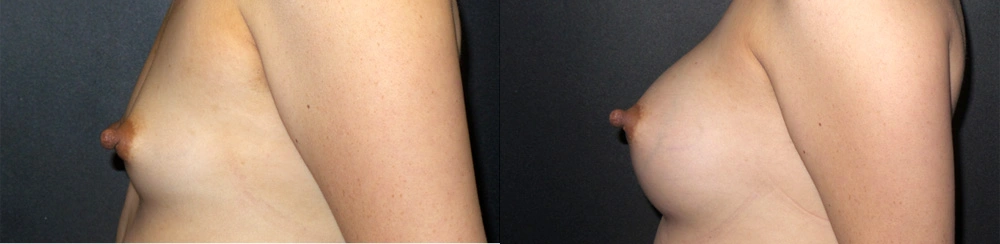 Real Patient Results in Newport Beach, CA. Preformed by Semira Bayait, MD, FACS.