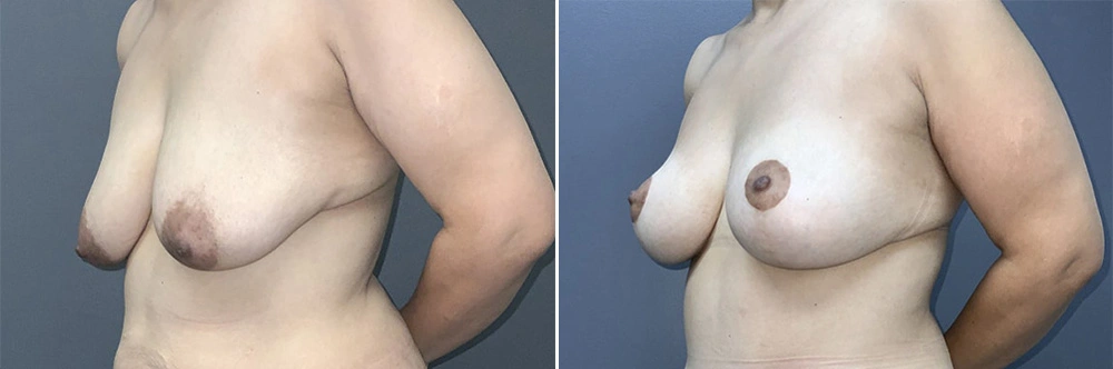 Real Patient Results in Newport Beach, CA. Preformed by Semira Bayait, MD, FACS.