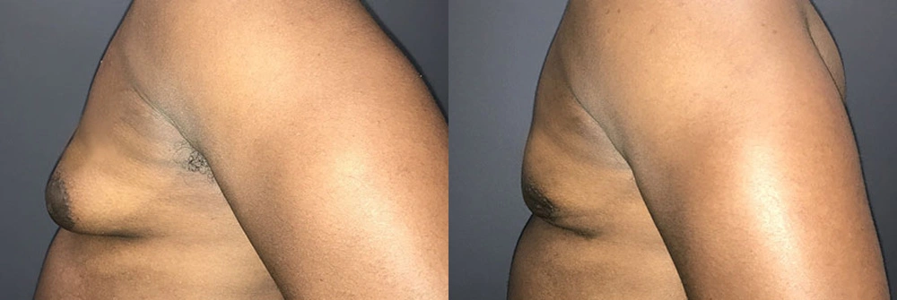 Real Patient Results in Newport Beach, CA. Preformed by Semira Bayait, MD, FACS.