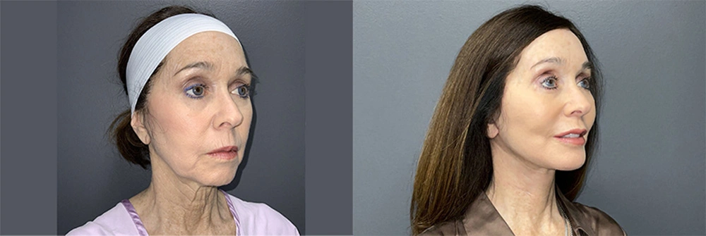 Real Patient Results in Newport Beach, CA. Preformed by Semira Bayait, MD, FACS.