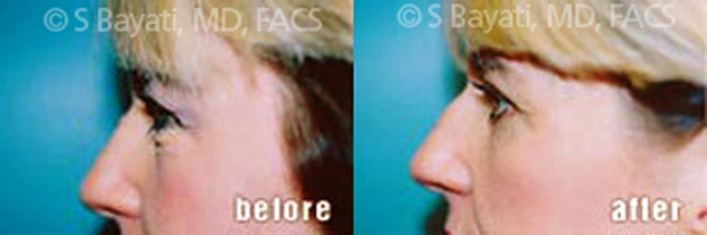 Real Patient Results in Newport Beach, CA. Preformed by Semira Bayait, MD, FACS.