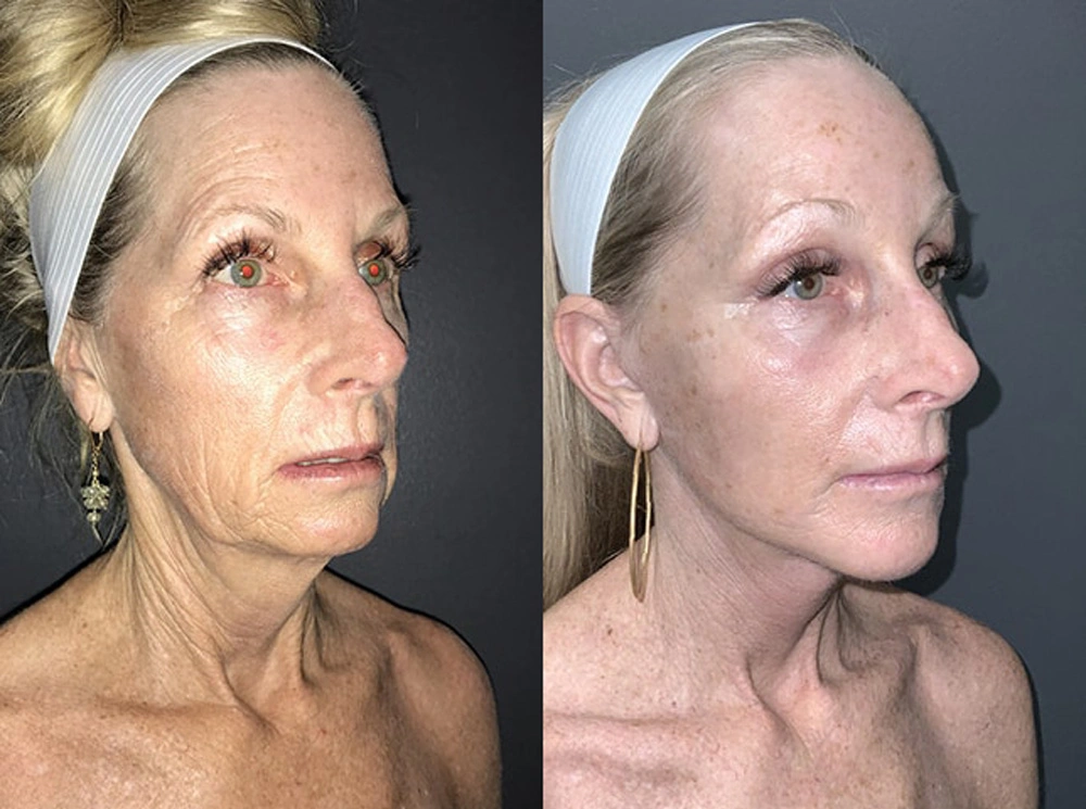 Real Patient Results in Newport Beach, CA. Preformed by Semira Bayait, MD, FACS.