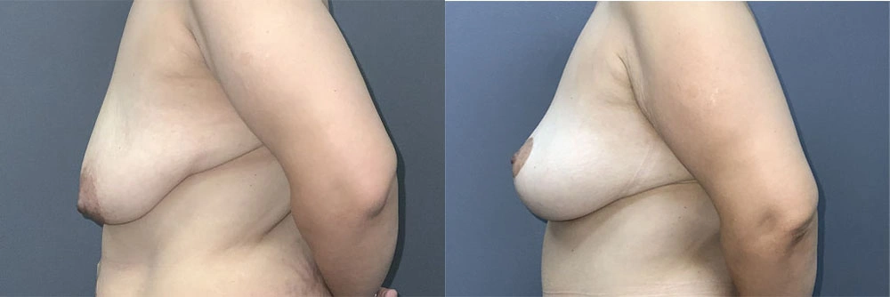 Real Patient Results in Newport Beach, CA. Preformed by Semira Bayait, MD, FACS.