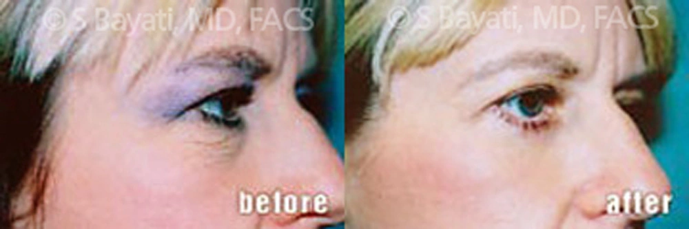 Real Patient Results in Newport Beach, CA. Preformed by Semira Bayait, MD, FACS.