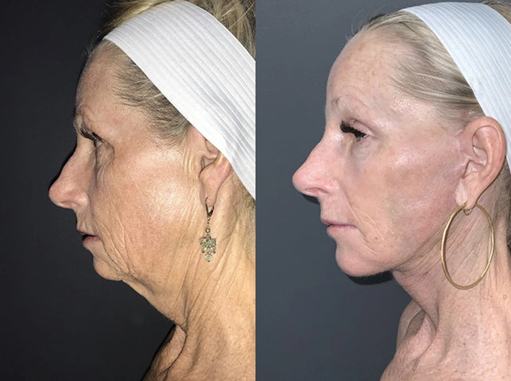 Real Patient Results in Newport Beach, CA. Preformed by Semira Bayait, MD, FACS.