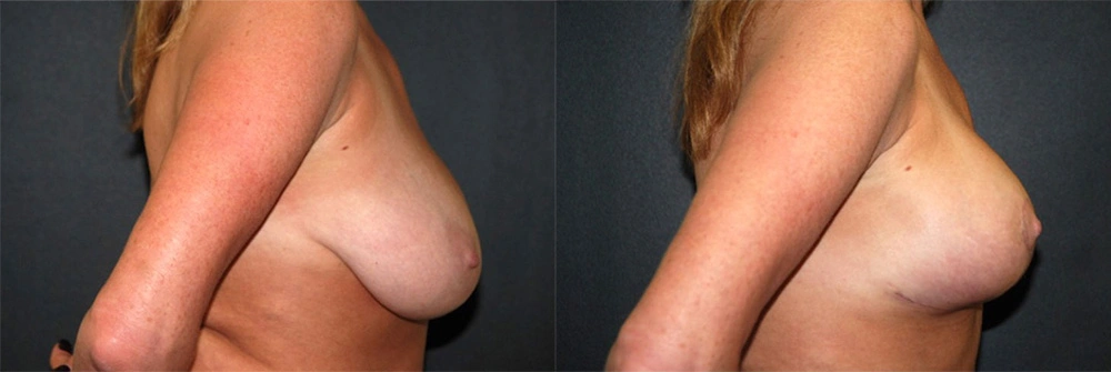 Real Patient Results in Newport Beach, CA. Preformed by Semira Bayait, MD, FACS.