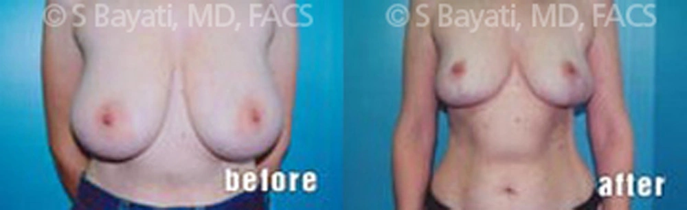 Real Patient Results in Newport Beach, CA. Preformed by Semira Bayait, MD, FACS.