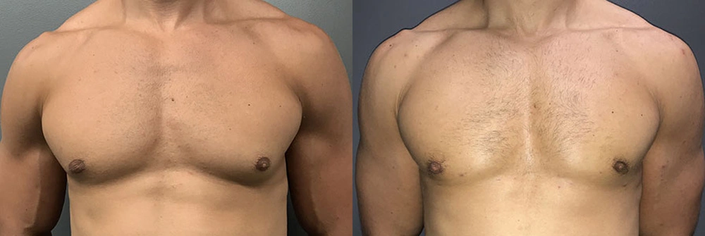 Real Patient Results in Newport Beach, CA. Preformed by Semira Bayait, MD, FACS.