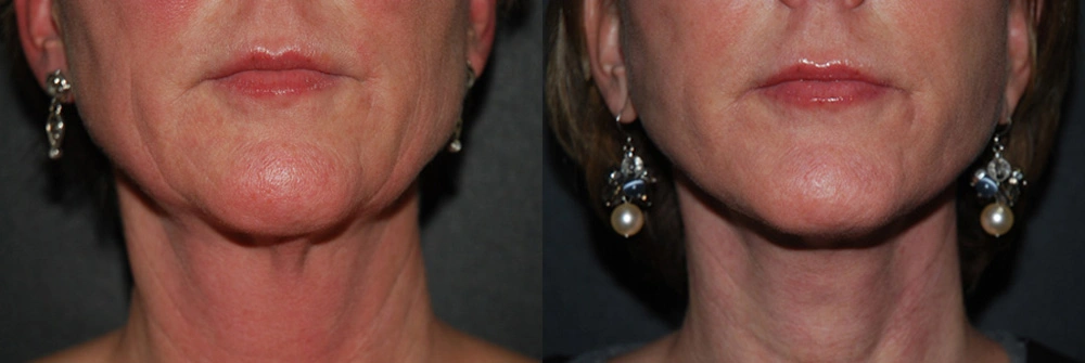 Real Patient Results in Newport Beach, CA. Preformed by Semira Bayait, MD, FACS.